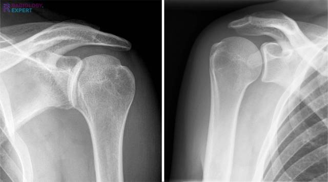 Trough line sign in posterior shoulder luxation.