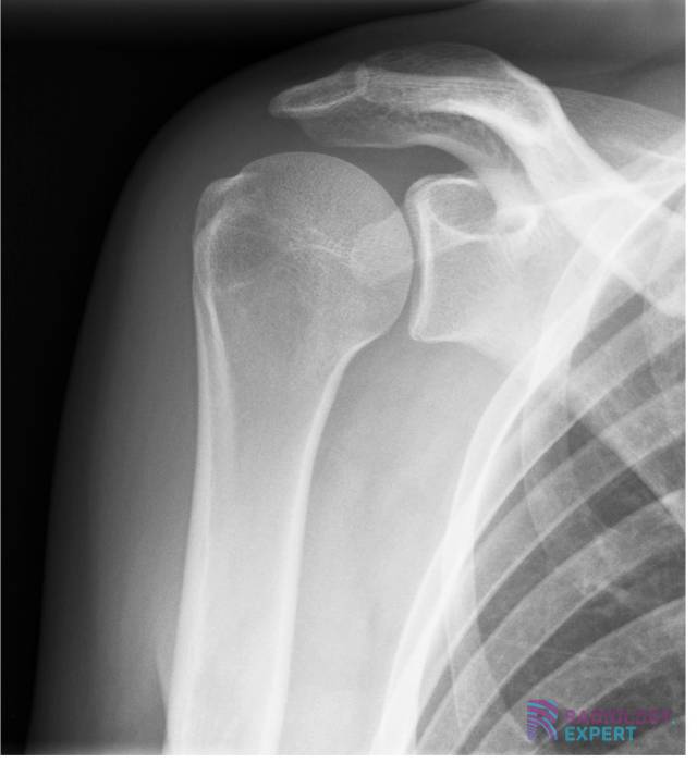 Normale schouder anatomie bij een AP-opname in exorotatie.