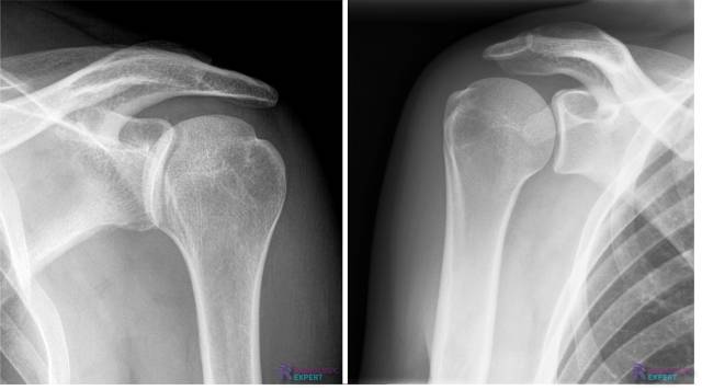 Trough line sign  bij een posterieure schouderluxatie.