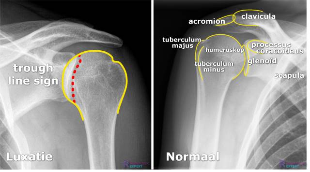 Trough line sign  bij een posterieure schouderluxatie.