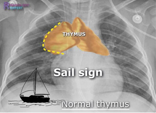 Normal thymus; sail sign