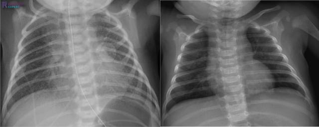 x ray for kids chest