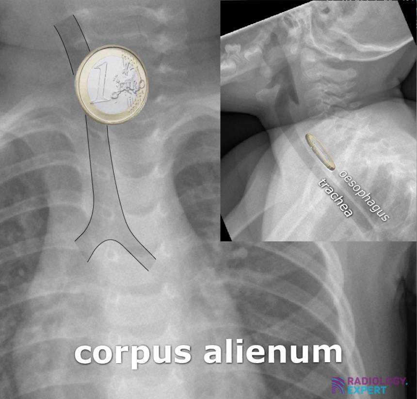 Coin Stack Sign Radiology Chest X-ray child