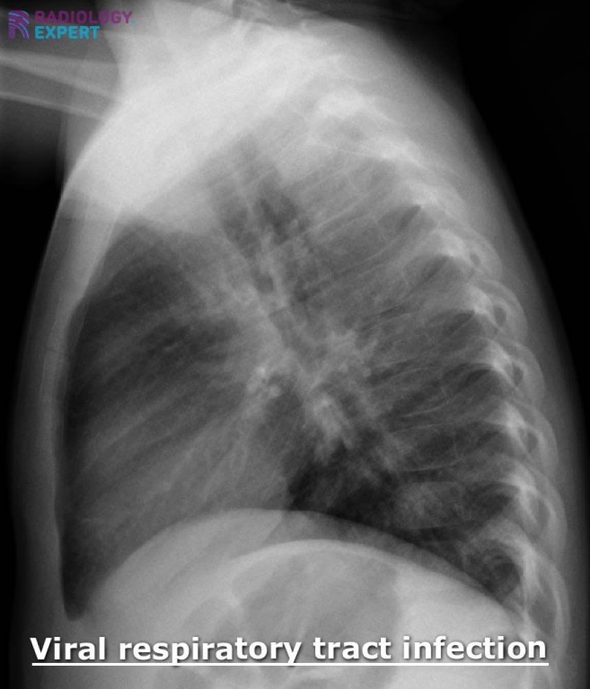 Chest X-ray child
