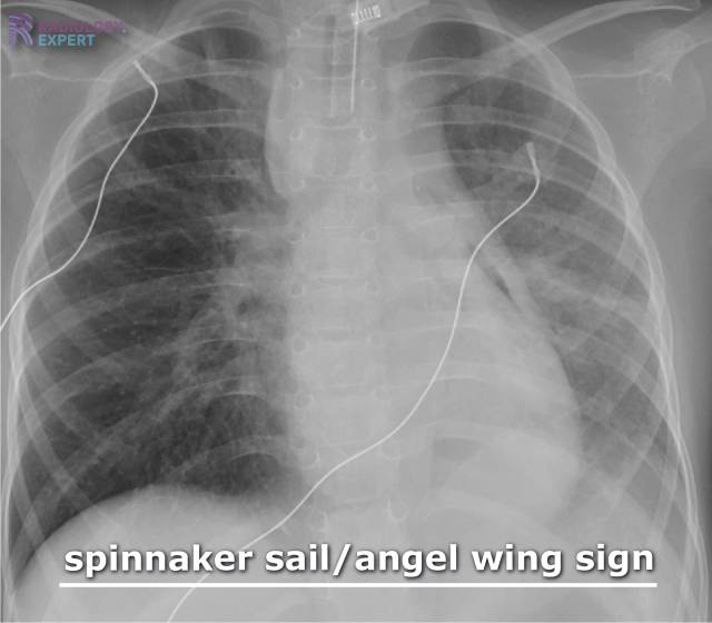 Spinacker Sign X-Thorax kind