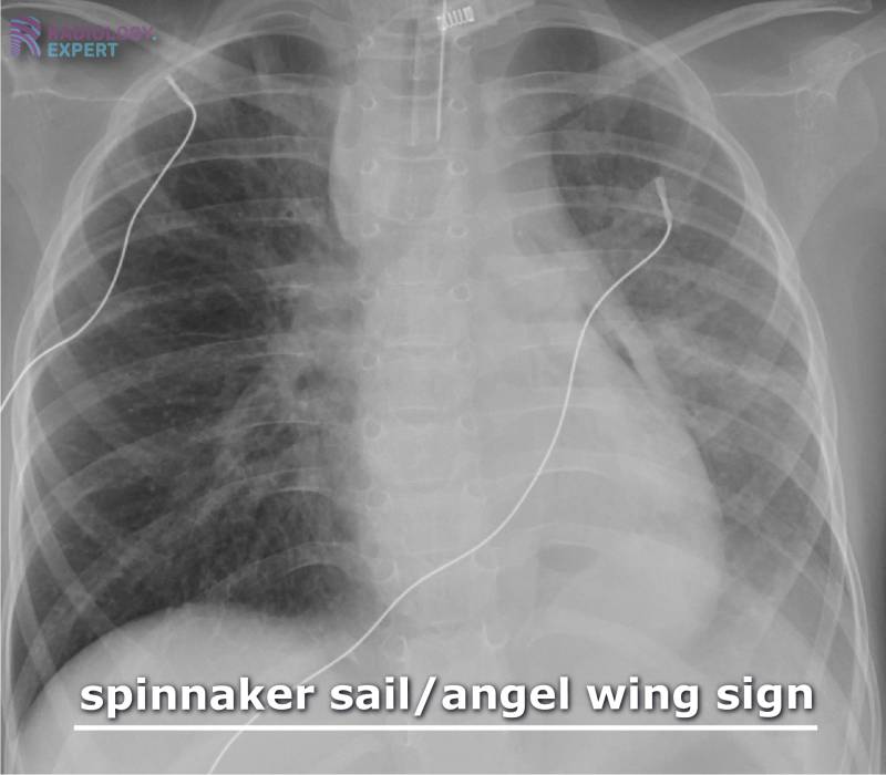 Spinacker Sign X-Thorax kind