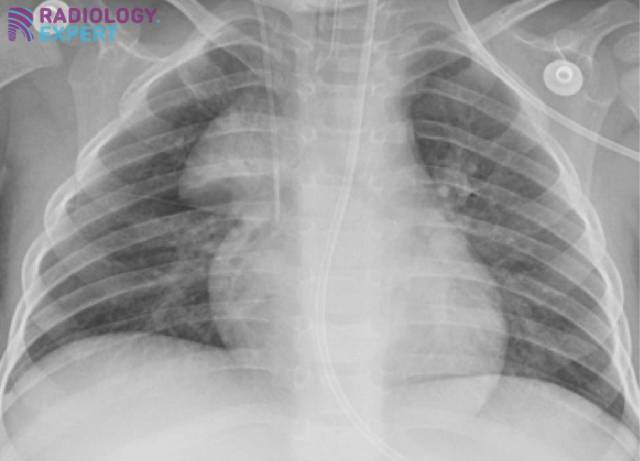 Vormvariant vnormale thymus; sail sign.