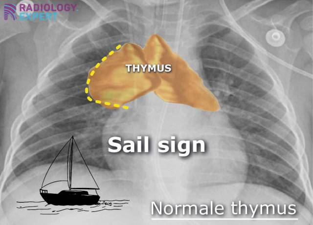 Vormvariant vnormale thymus; sail sign.