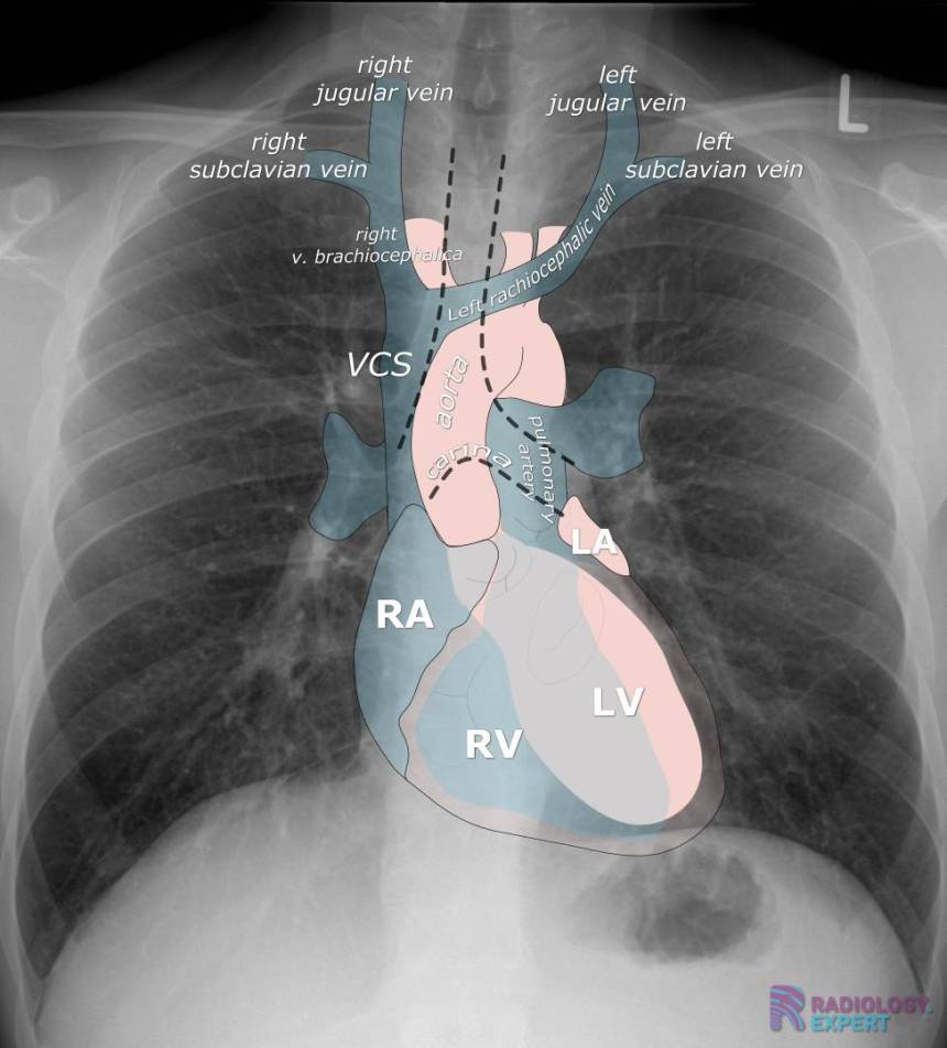 Chest Xray ICU