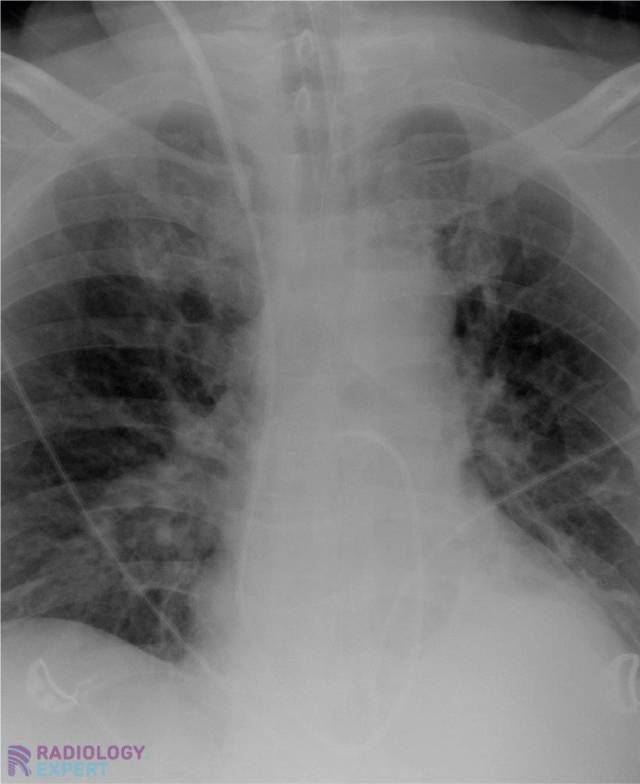 Swan-Ganz catheter in pulmonary artery