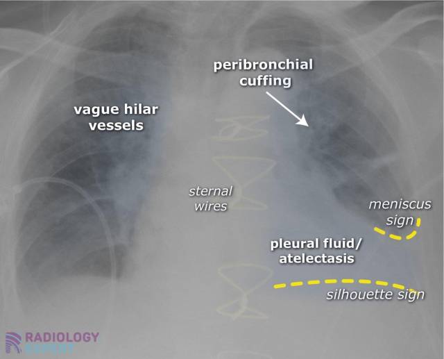 Chest Xray ICU