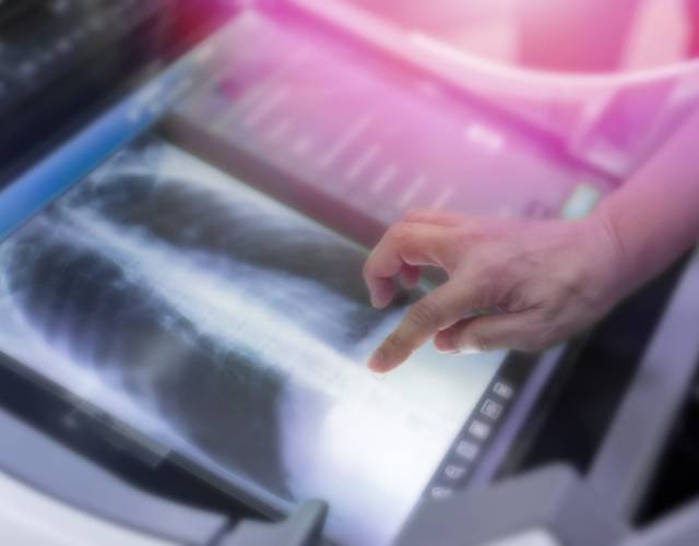 Chest X-ray ICU