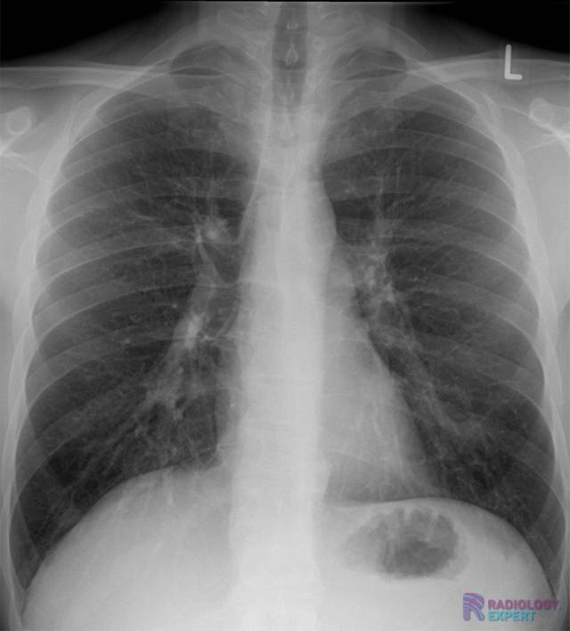 Chest Xray