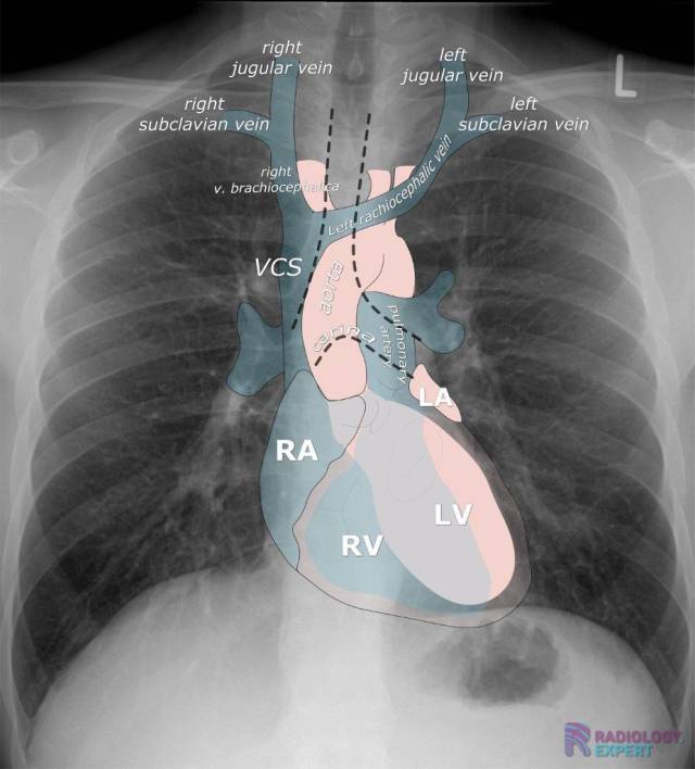 X Ray Heart Anatomy