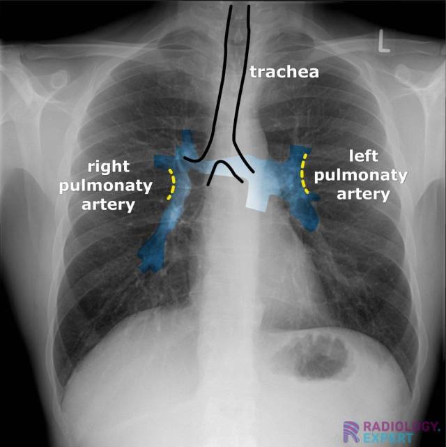 Chest X ray chest-x-ray