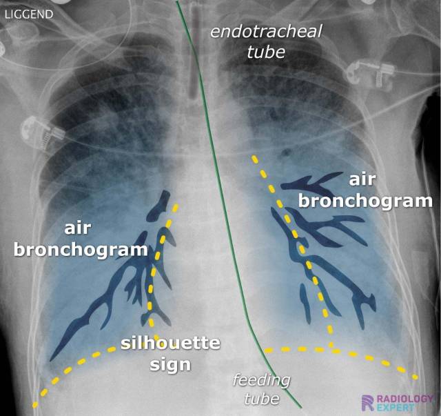 Chest X ray chest-x-ray
