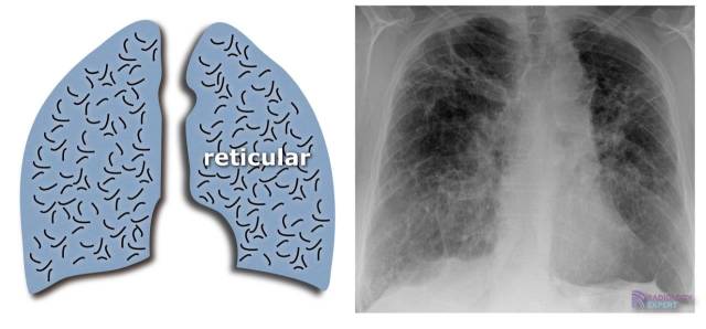 Chest X ray chest-x-ray