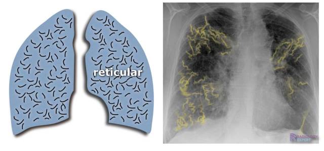 Chest X ray loss-of-lung-markings-chest-x-ray-medschool