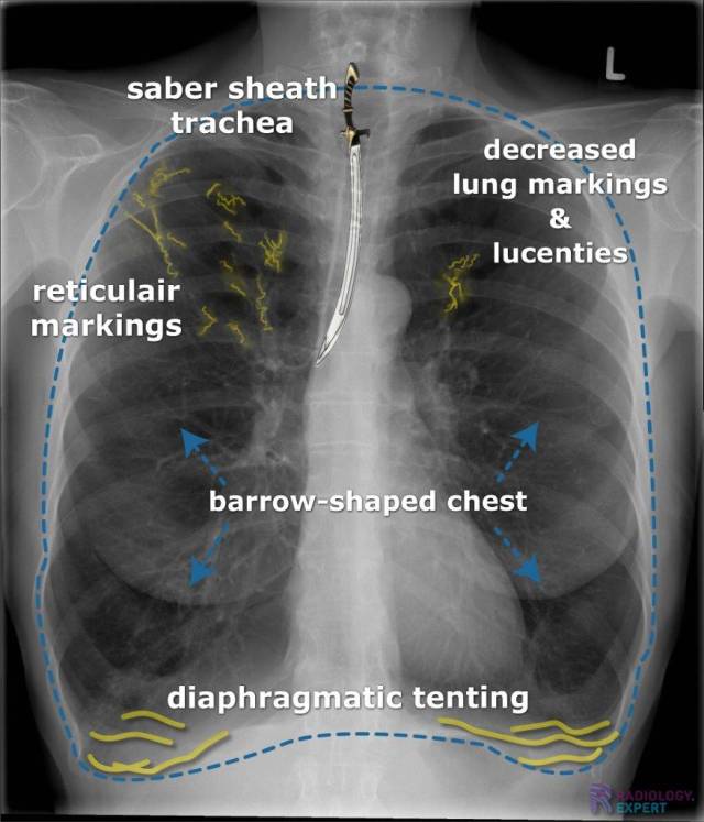 Copd chest x ray frequency