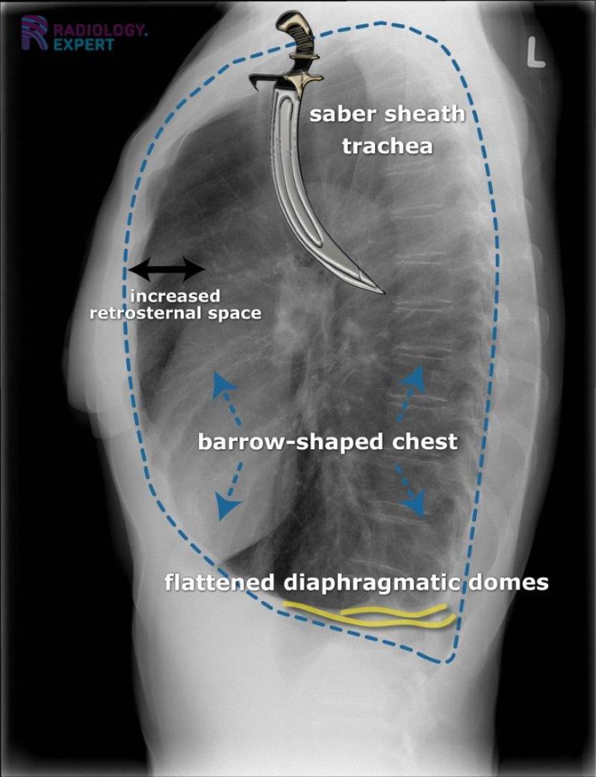 Chest Xray