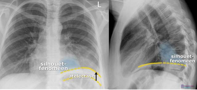 X-Thorax