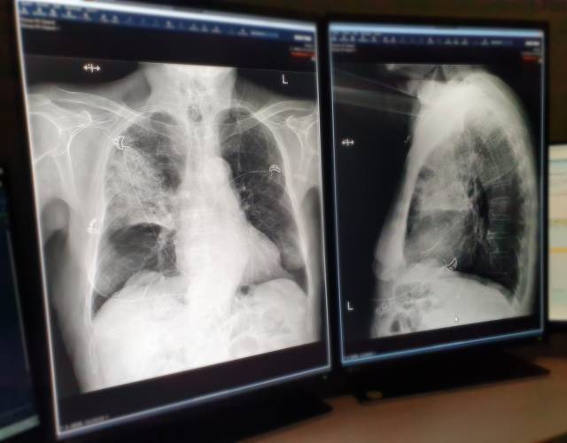 X-Thorax