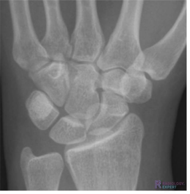 Normale anatomie carpalia.